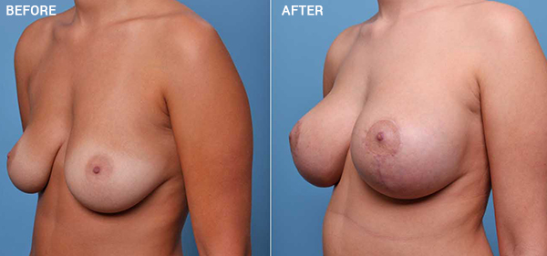 A result from Nebraska Medicine Village Pointe Aesthetic Surgery | Dreams MedSpa