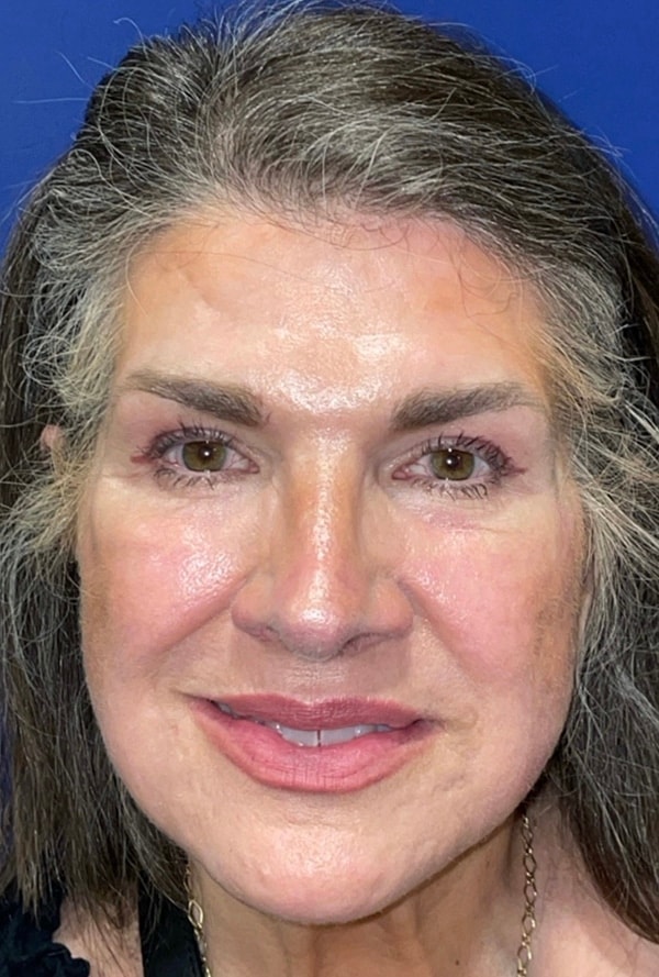 A result from Idaho Eyelid & Facial Plastic Surgery