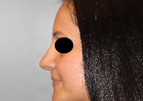 Rhinoplasty result at Richards Cosmetic Surgery