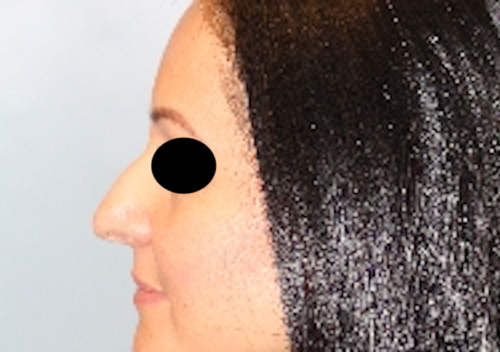 Rhinoplasty before photo
