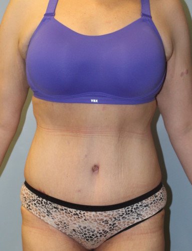 Tummy Tuck result at Richards Cosmetic Surgery