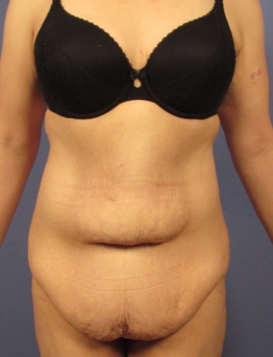 Tummy Tuck before photo