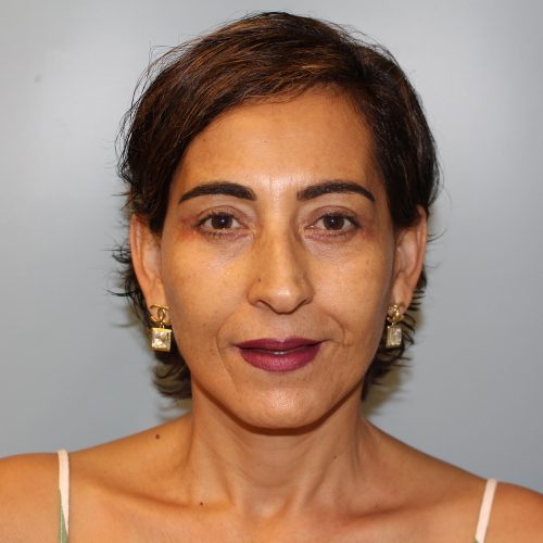 Blepharoplasty result at Richards Cosmetic Surgery