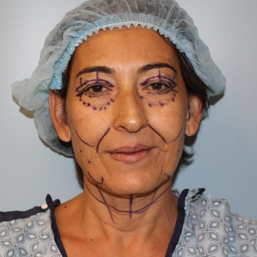 Blepharoplasty before photo