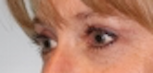 Blepharoplasty result at Richards Cosmetic Surgery