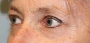 Blepharoplasty before photo