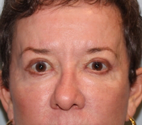 Blepharoplasty result at Richards Cosmetic Surgery