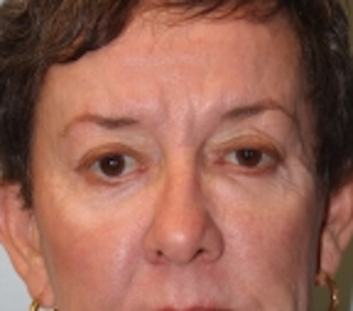 Blepharoplasty before photo