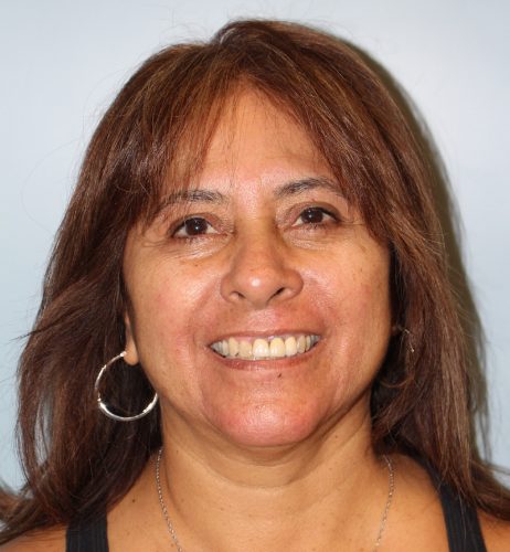 Blepharoplasty result at Richards Cosmetic Surgery