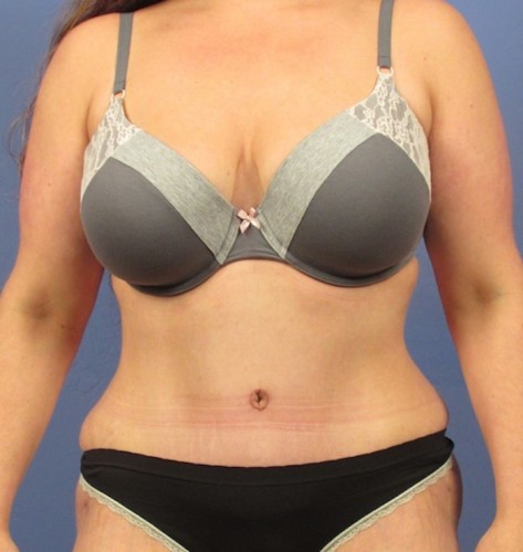 Tummy Tuck result at Richards Cosmetic Surgery