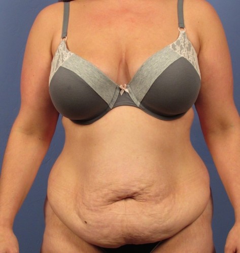 Tummy Tuck before photo