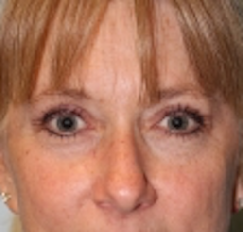Blepharoplasty result at Richards Cosmetic Surgery