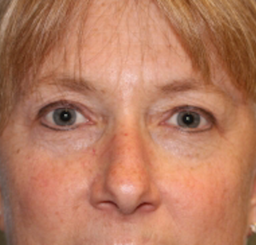 Blepharoplasty before photo