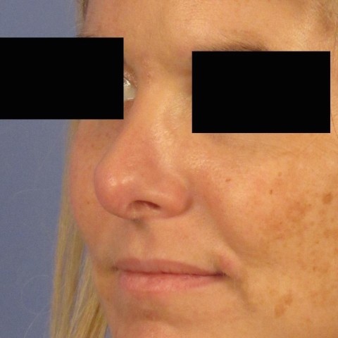 Rhinoplasty result at Richards Cosmetic Surgery