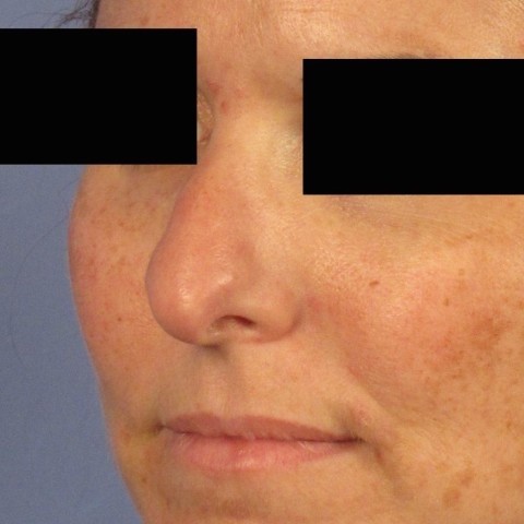 Rhinoplasty before photo