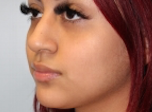 Rhinoplasty before photo