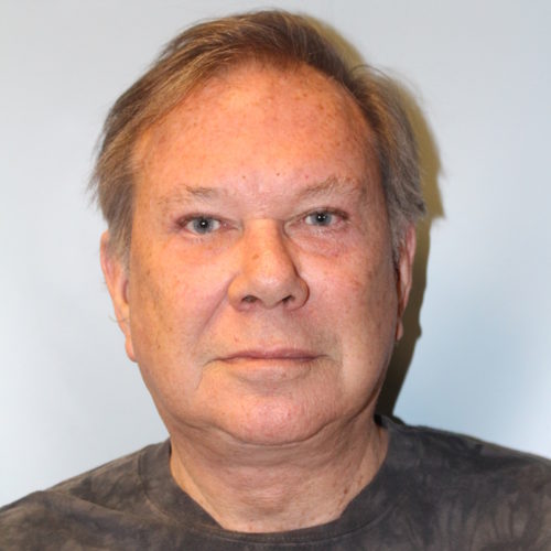 Blepharoplasty result at Richards Cosmetic Surgery
