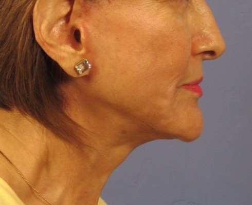 A result from Richards Cosmetic Surgery