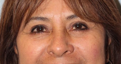 Blepharoplasty result at Richards Cosmetic Surgery