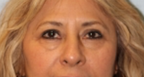 Blepharoplasty before photo