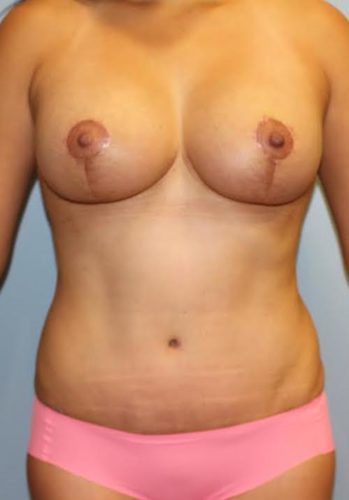 Mommy Makeover result at Richards Cosmetic Surgery
