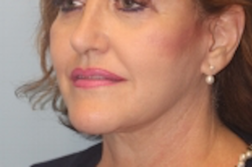 Rhinoplasty result at Richards Cosmetic Surgery