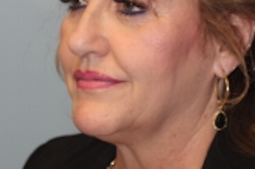 Rhinoplasty before photo