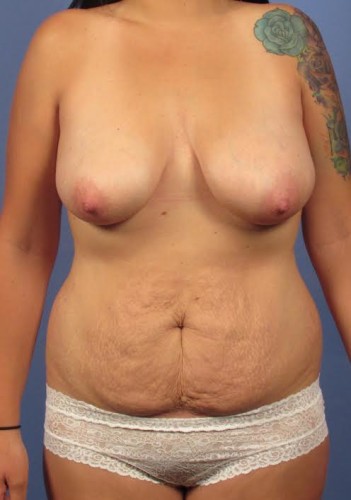 Tummy Tuck before photo