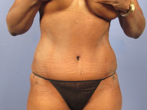Tummy Tuck result at Richards Cosmetic Surgery