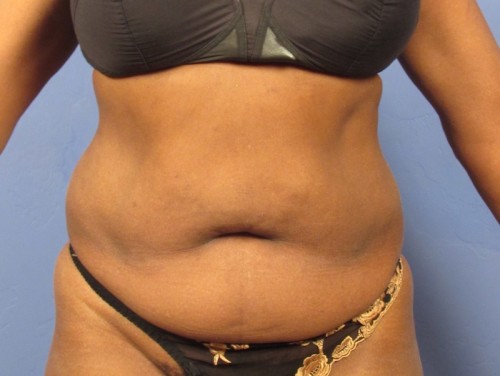 Tummy Tuck before photo