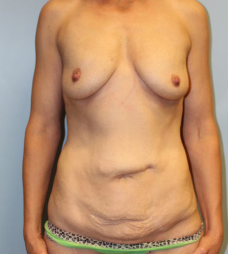 Mommy Makeover before photo
