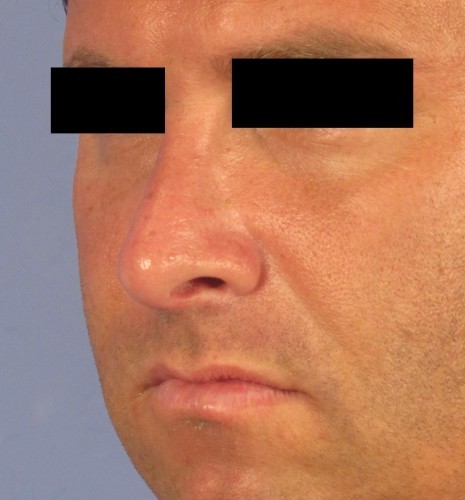 Rhinoplasty result at Richards Cosmetic Surgery