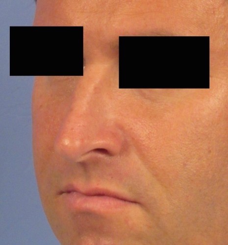 Rhinoplasty before photo
