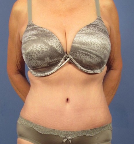Tummy Tuck result at Richards Cosmetic Surgery