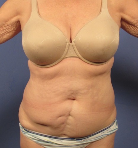 Tummy Tuck before photo
