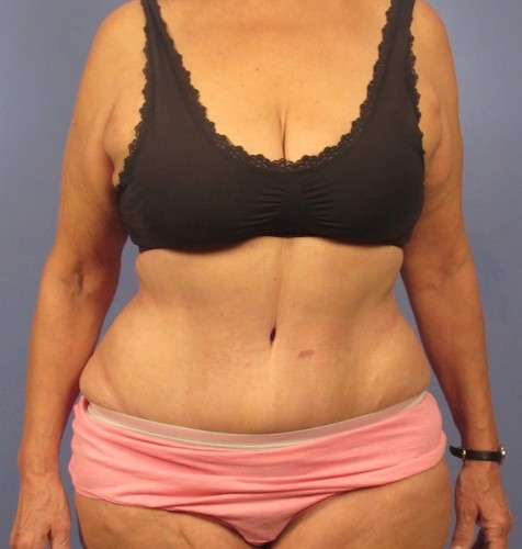 Tummy Tuck result at Richards Cosmetic Surgery