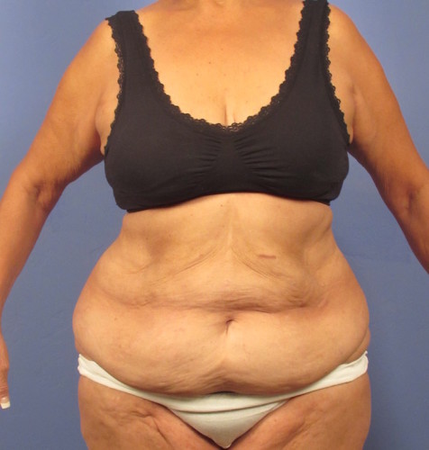 Tummy Tuck before photo
