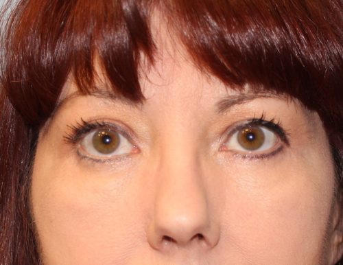 Blepharoplasty result at Richards Cosmetic Surgery