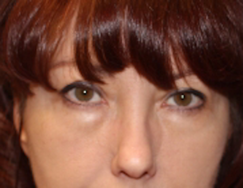 Blepharoplasty before photo