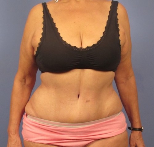 Tummy Tuck result at Richards Cosmetic Surgery
