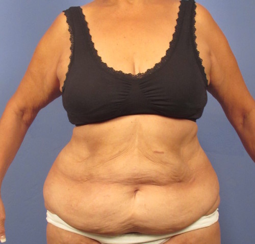 Tummy Tuck before photo