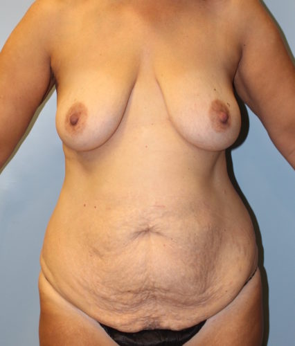 Mommy Makeover before photo
