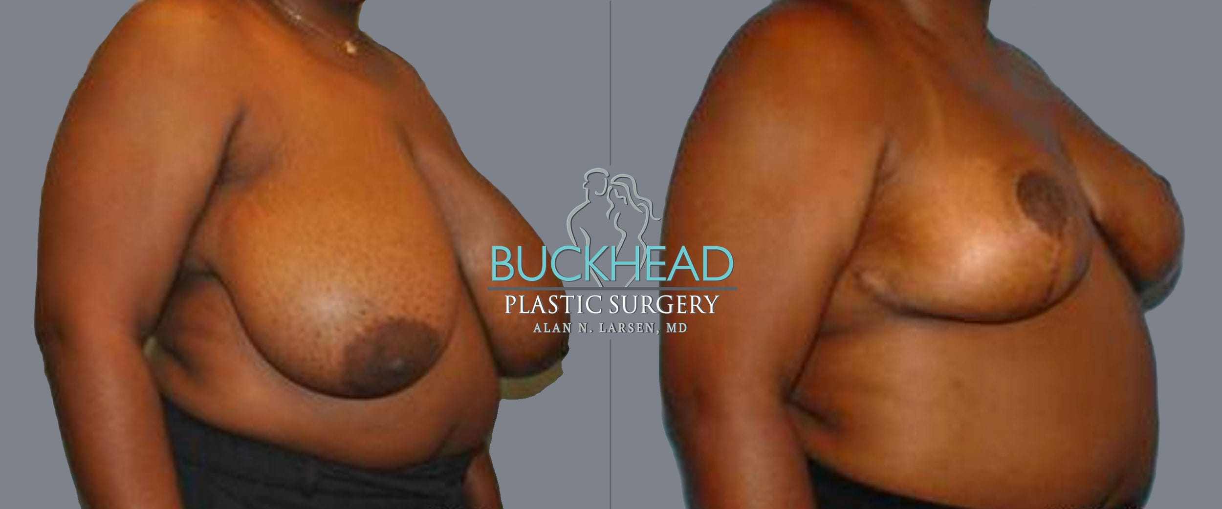 A result from Buckhead Plastic Surgery (Alan N. Larsen MD)