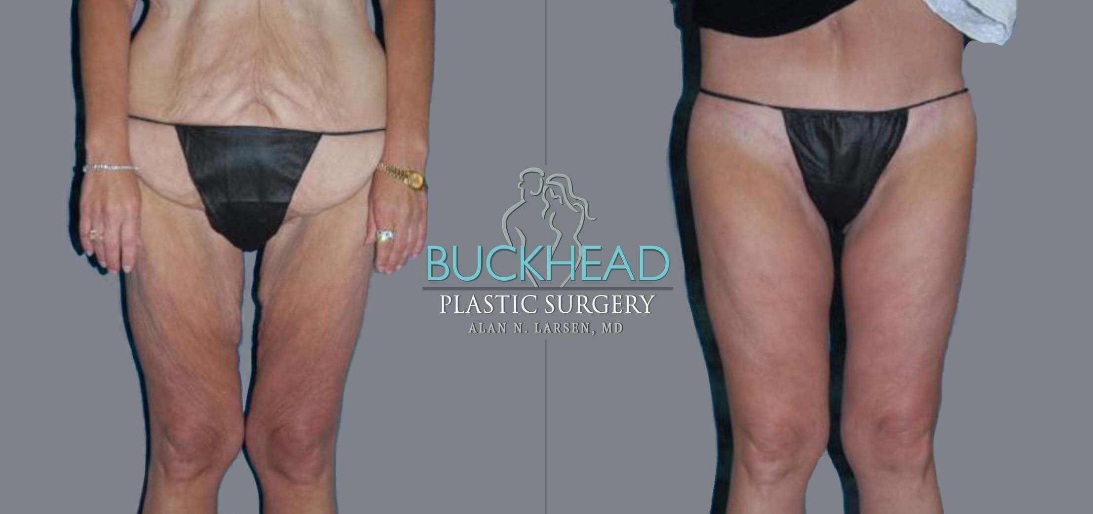 A result from Buckhead Plastic Surgery (Alan N. Larsen MD)