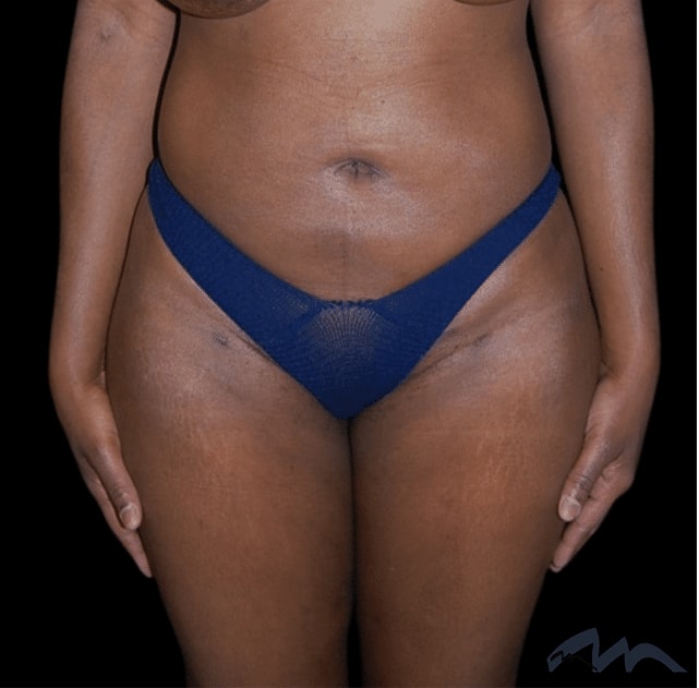 A result from Miami Plastic Surgery