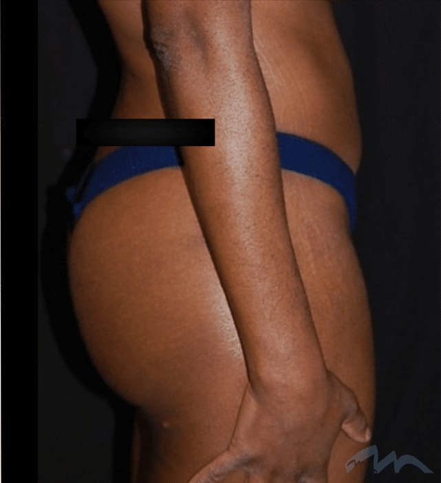 A result from Miami Plastic Surgery