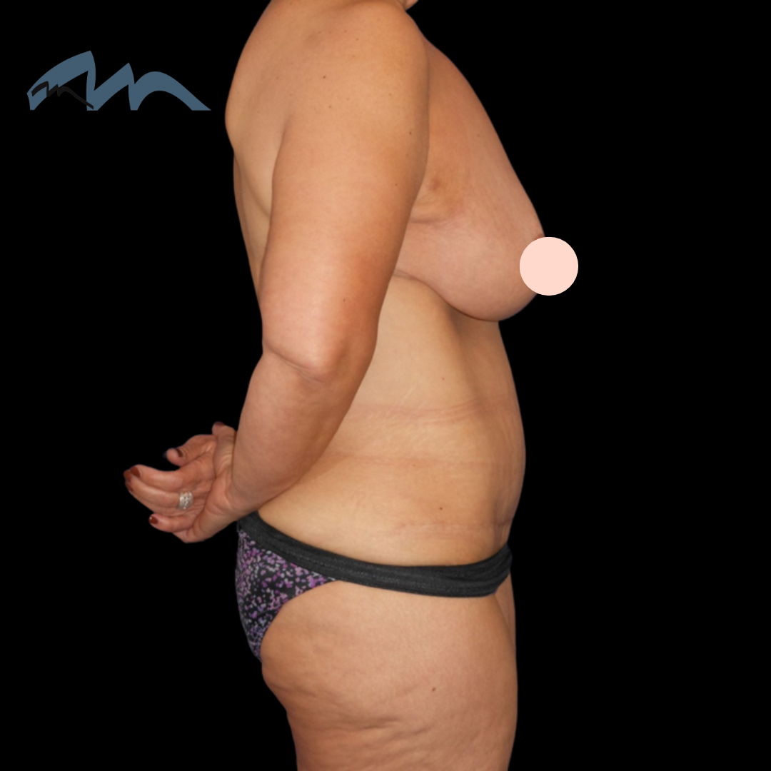 A result from Miami Plastic Surgery