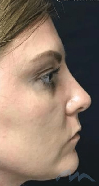 A result from Miami Plastic Surgery