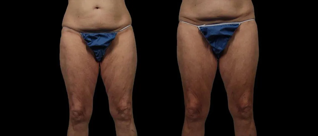 A result from Marietta Plastic Surgery