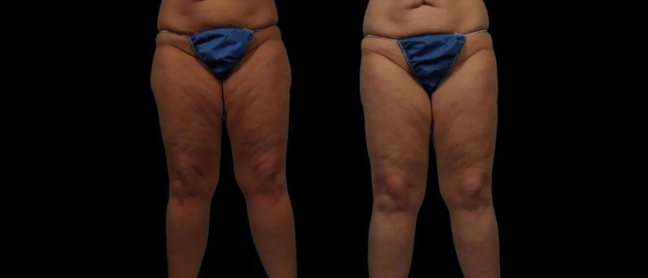 A result from Marietta Plastic Surgery
